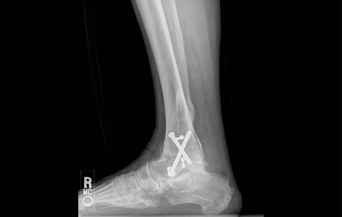 Best Countries and Hospitals for Ankle Fusion Surgery Abroad related image