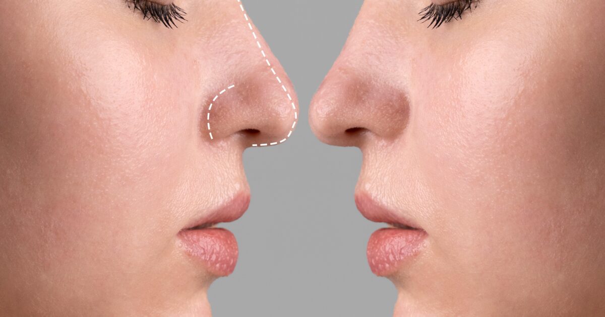 The 7 Best and Cheapest Countries for Rhinoplasty Surgery related image