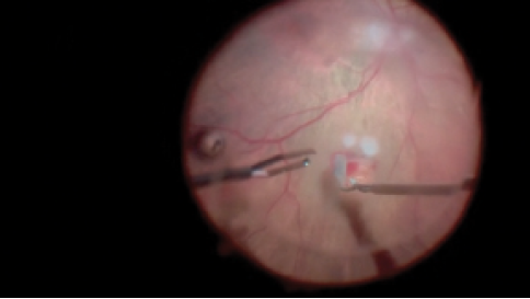 Retinal Transplant in Turkey - Best Clinics and Surgeons related image