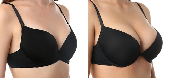 Breast Job in Turkey - Lower Costs, Packages & Best Clinics related image