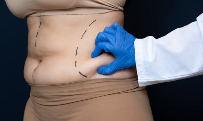 Tummy Tuck in Turkey - All-Inclusive Packages from €3700 related image
