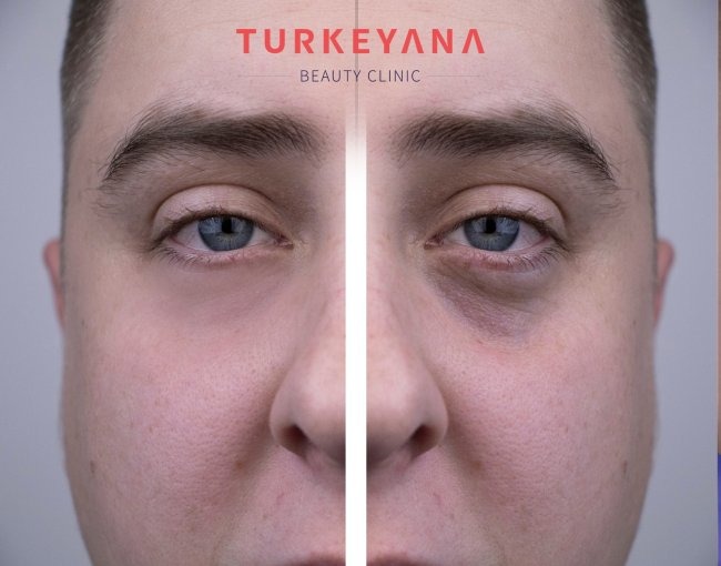 Eyelid Surgery (Blepharoplasty) in Turkey related image