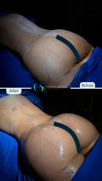 BBL in Turkey (Brazilian Butt Lift) related image
