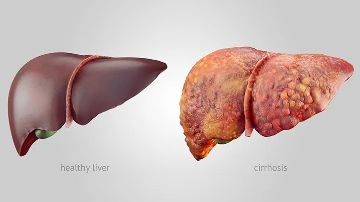 Liver Cirrhosis Treatment in Turkey - Best Clinics and Costs related image