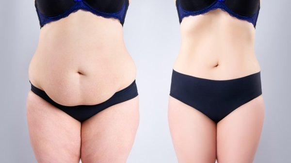 Tummy Tuck in Turkey - All-Inclusive Packages from €3700 related image