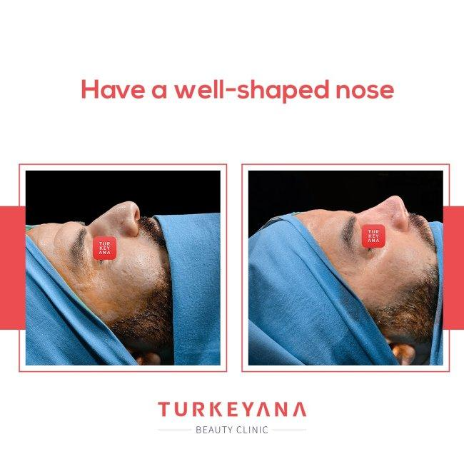 Why Turkish Rhinoplasty Surgery Is So Popular? related image