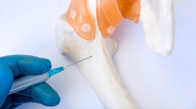 Bone Marrow Transplantation in Turkey - Costs & Best Clinics related image