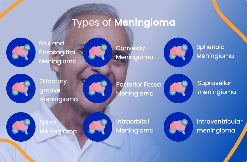 Meningioma (Brain Tumor) Removal Surgery in Turkey related image