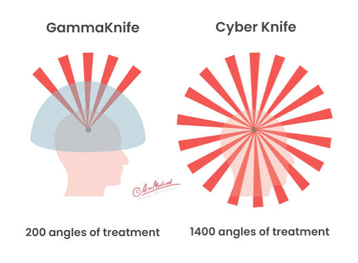 Meningioma (Brain Tumor) Removal Surgery in Turkey related image