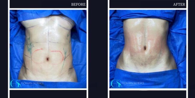 Liposuction in Turkey - Best Clinics, Costs and Packages related image