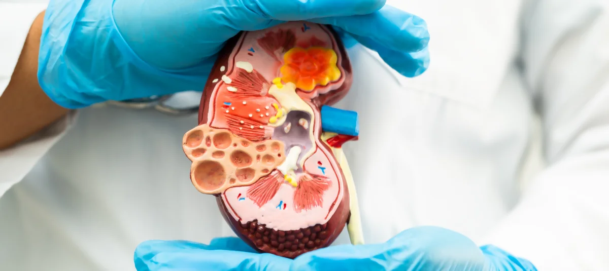 Kidney Transplant in Turkey 2025 - Best Clinics & Surgeons related image