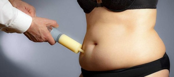 what is liposuction
