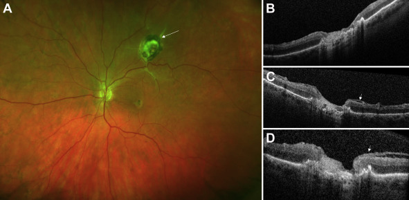 Retinal Transplant in Turkey - Best Clinics and Surgeons related image