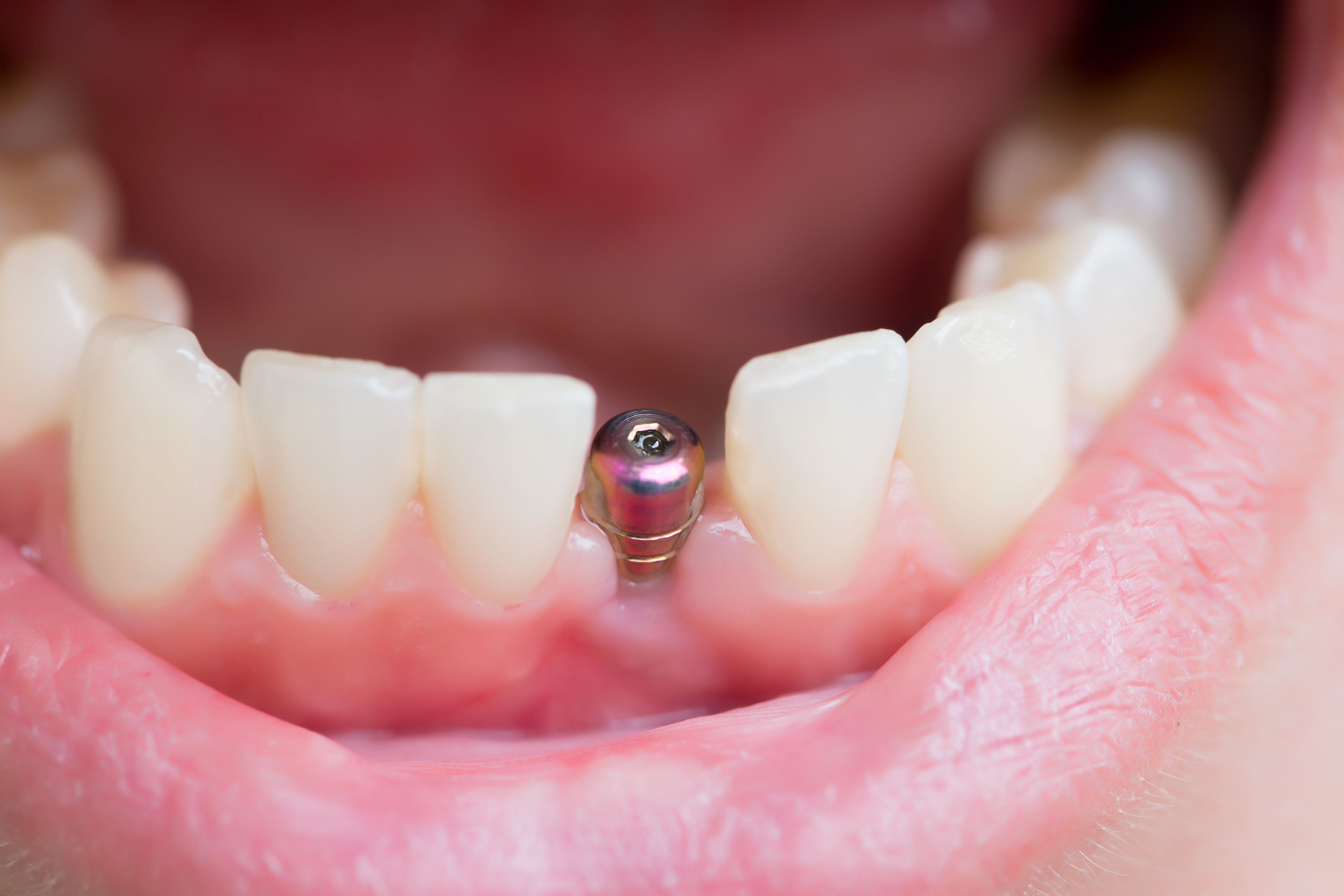 Top 11 Cheapest and Best Countries for All-on-4 Dental Implants related image
