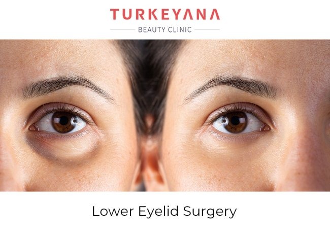 Eyelid Surgery (Blepharoplasty) in Turkey related image