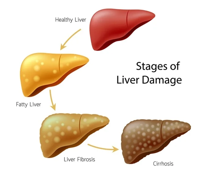 Liver Cirrhosis Treatment in Turkey - Best Clinics and Costs related image