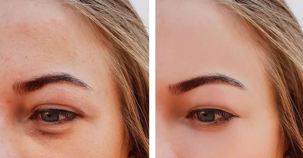 Eyelid Surgery (Blepharoplasty) in Turkey (2026) related image