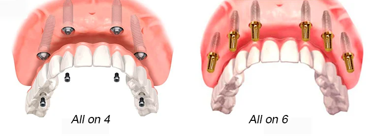 Top 11 Cheapest and Best Countries for All-on-4 Dental Implants related image