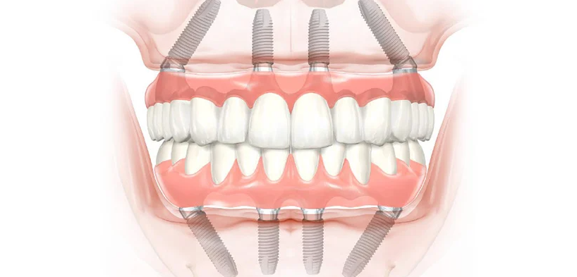 Top 11 Cheapest and Best Countries for All-on-4 Dental Implants related image