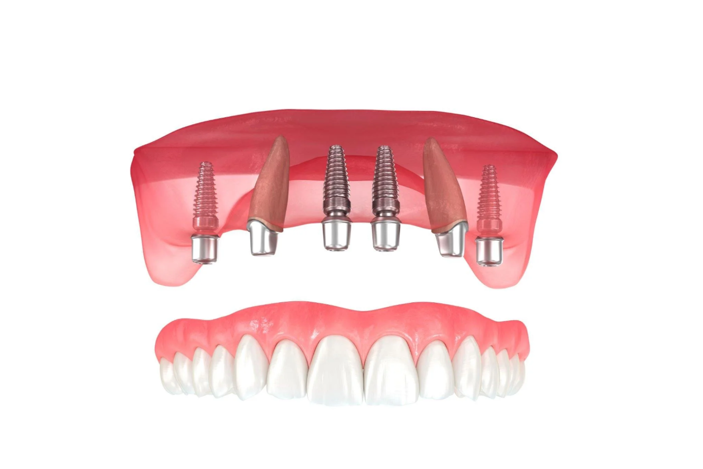 Top 11 Cheapest and Best Countries for All-on-4 Dental Implants related image