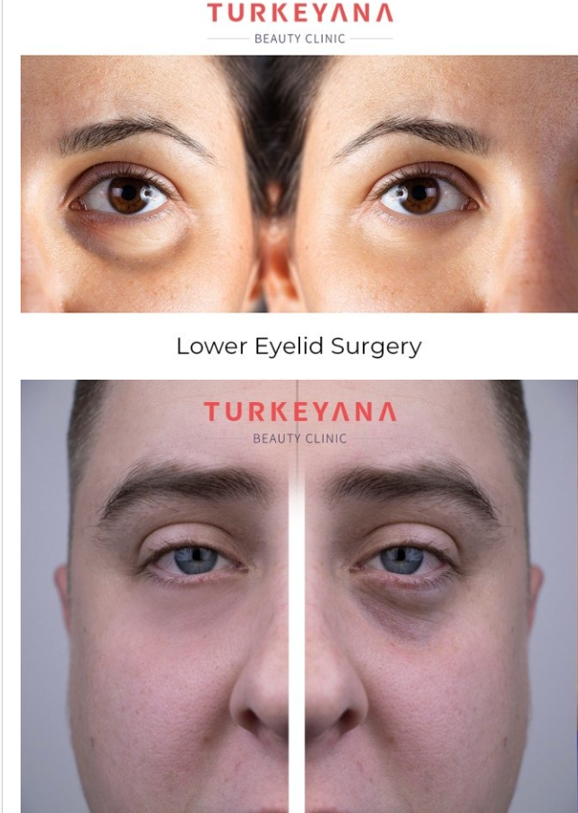 Eyelid Surgery (Blepharoplasty) in Turkey (2026) related image