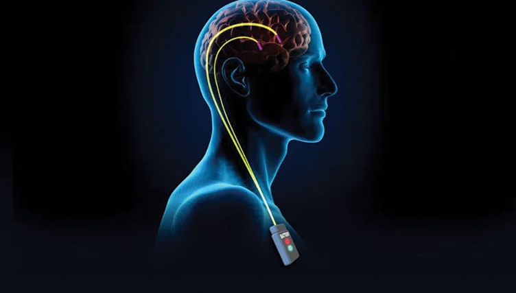 Deep Brain Stimulation in Turkey: A Complete Guide for 2026 related image