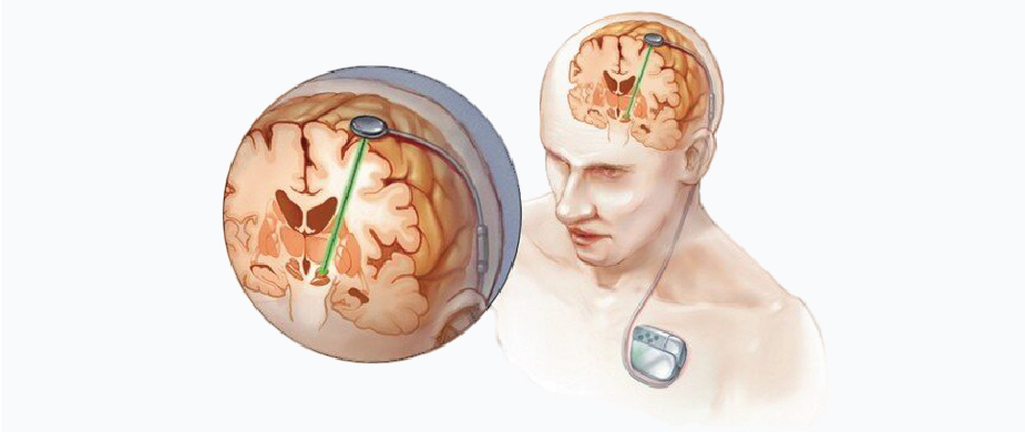 Deep Brain Stimulation in Turkey: A Complete Guide for 2026 related image