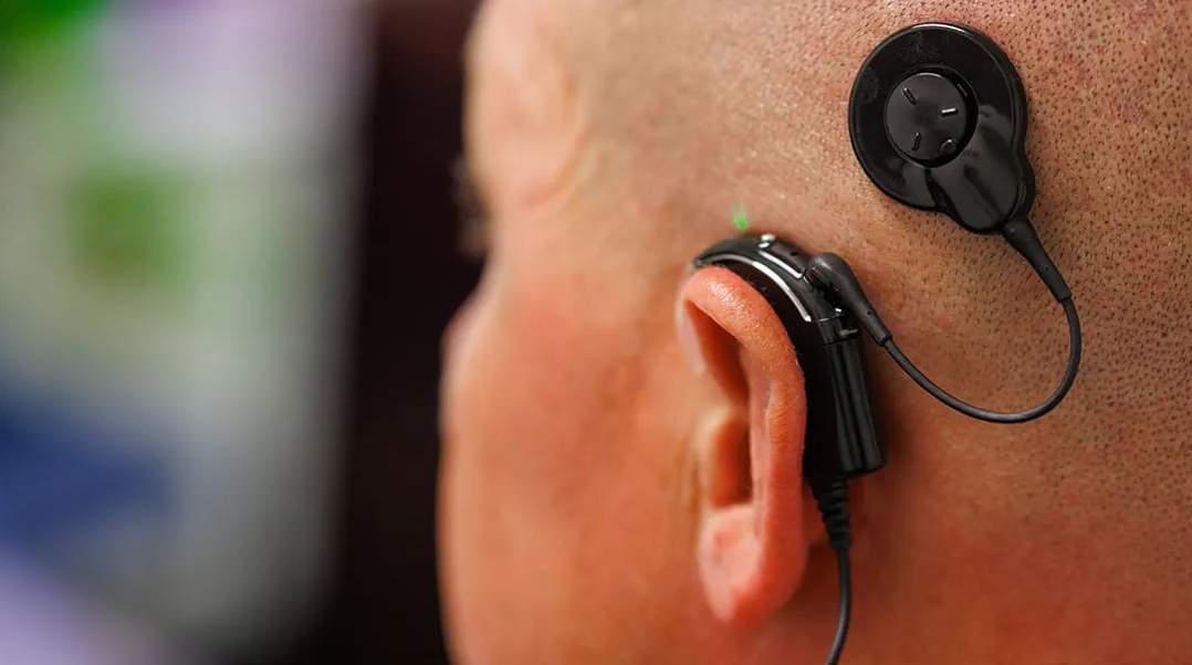 Cochlear Implant in Turkey - Clinics, Costs, Doctors (2026) related image