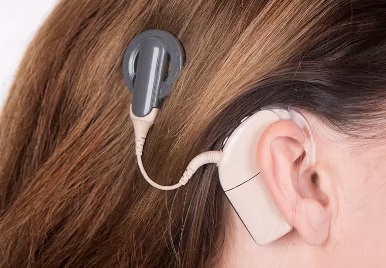 Cochlear Implant in Turkey - Clinics, Costs, Doctors (2026) related image