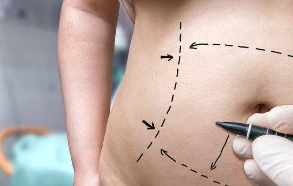 All-Inclusive Tummy Tuck in Turkey: Costs, Clinics, Packages related image