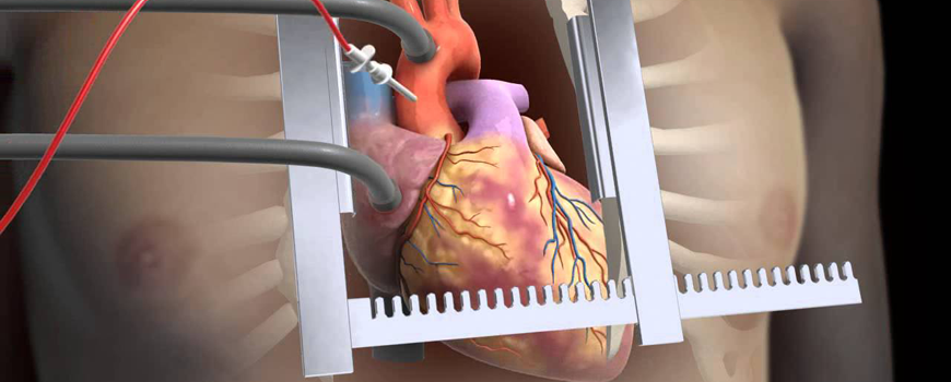 Heart Bypass Surgery in Turkey related image