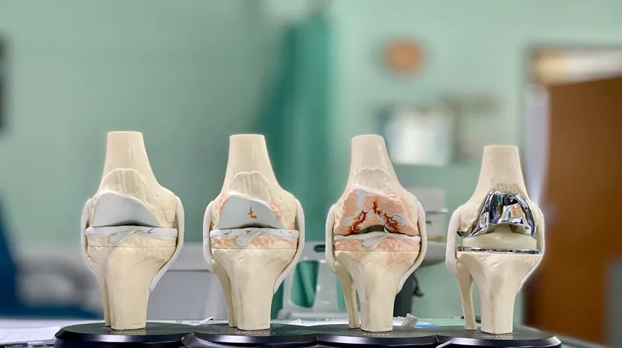 Best and Cheapest Countries for Hip Replacement Surgery Abroad related image