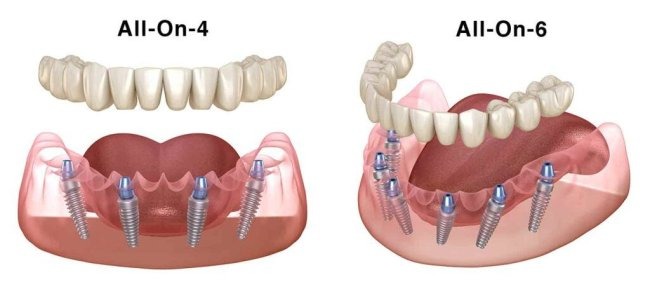 The Best and Cheapest Countries for All-on-6 Dental Implants related image