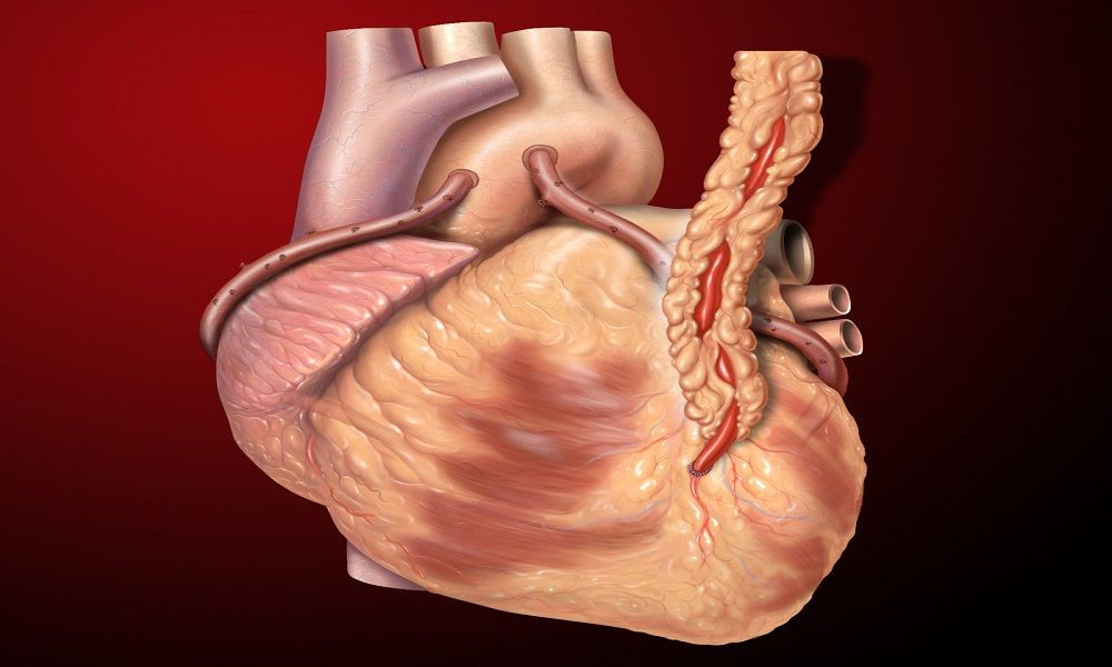 Heart Bypass Surgery in Turkey related image
