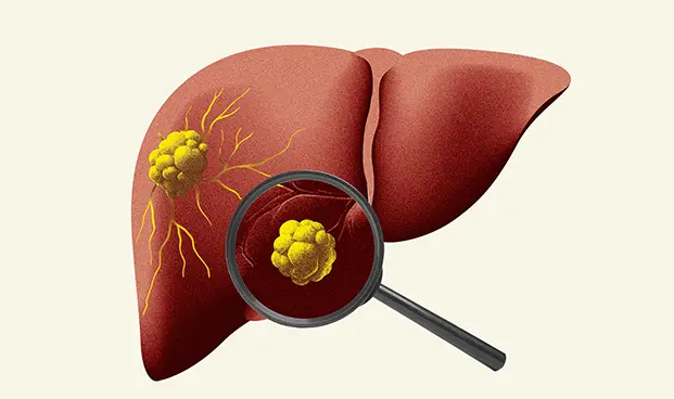 Liver Cancer Surgery in Turkey related image