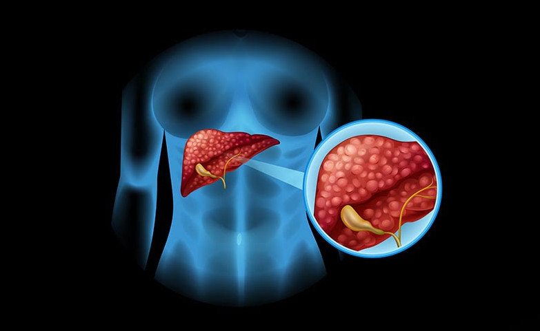 Liver Cancer Surgery in Turkey related image