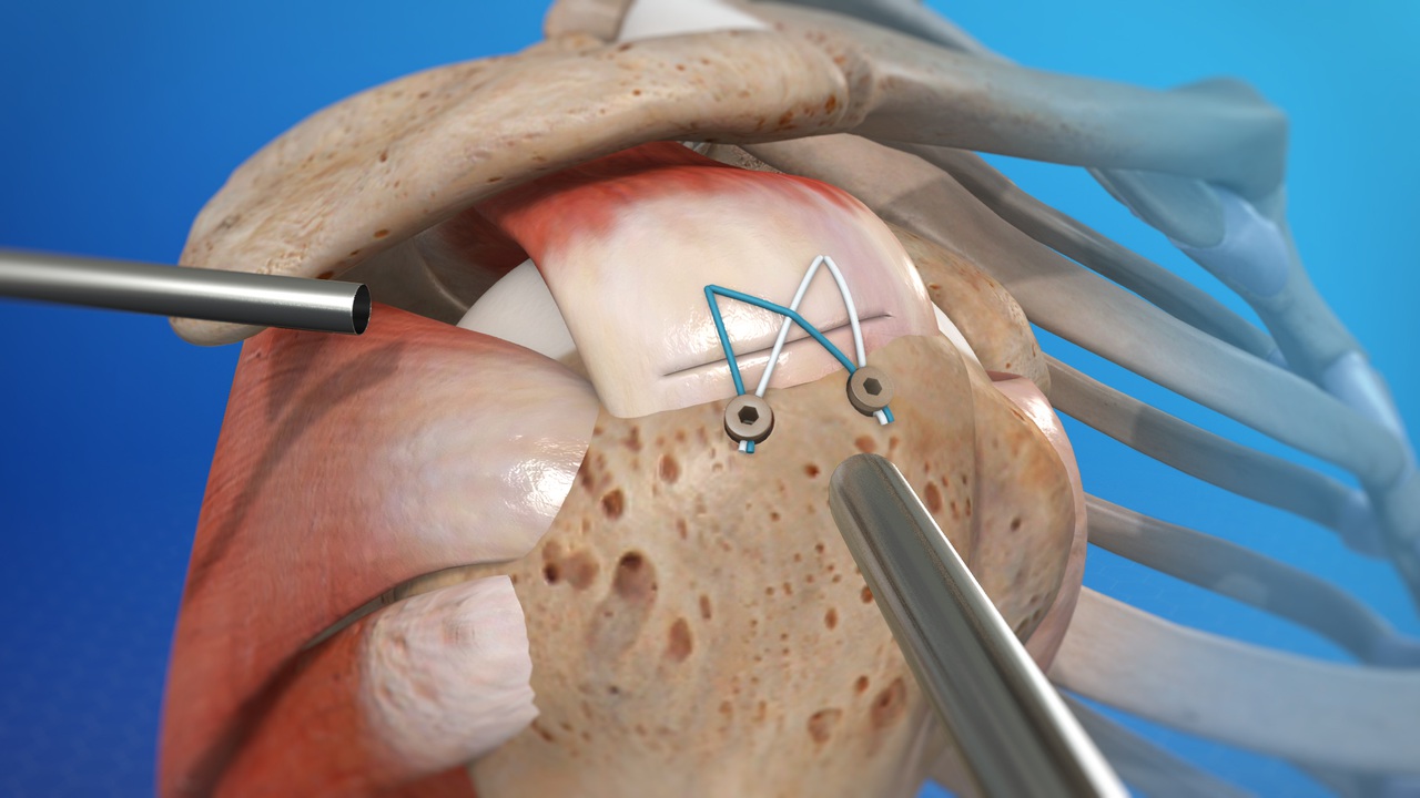 Arthroscopic Shoulder Surgery Abroad related image