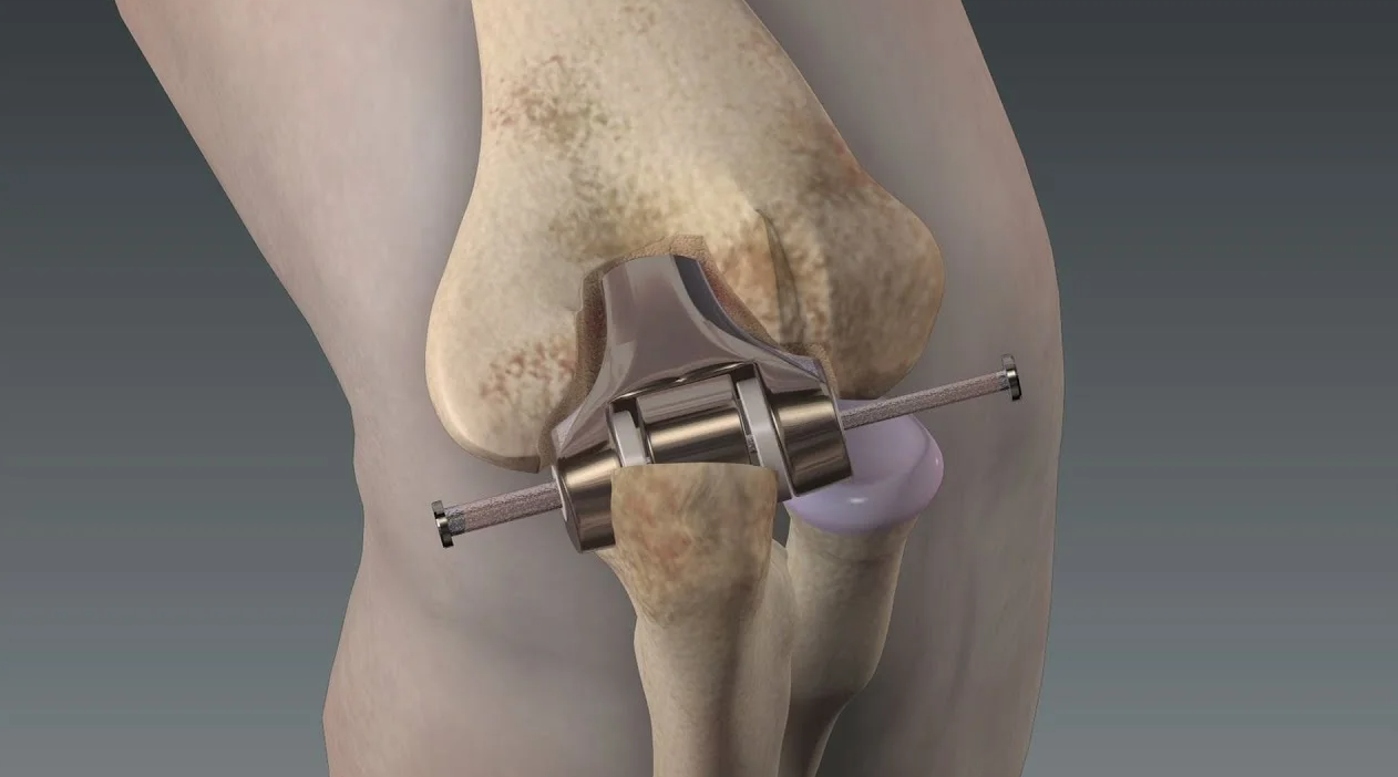 Best and Cheapest Countries for Hip Replacement Surgery Abroad related image
