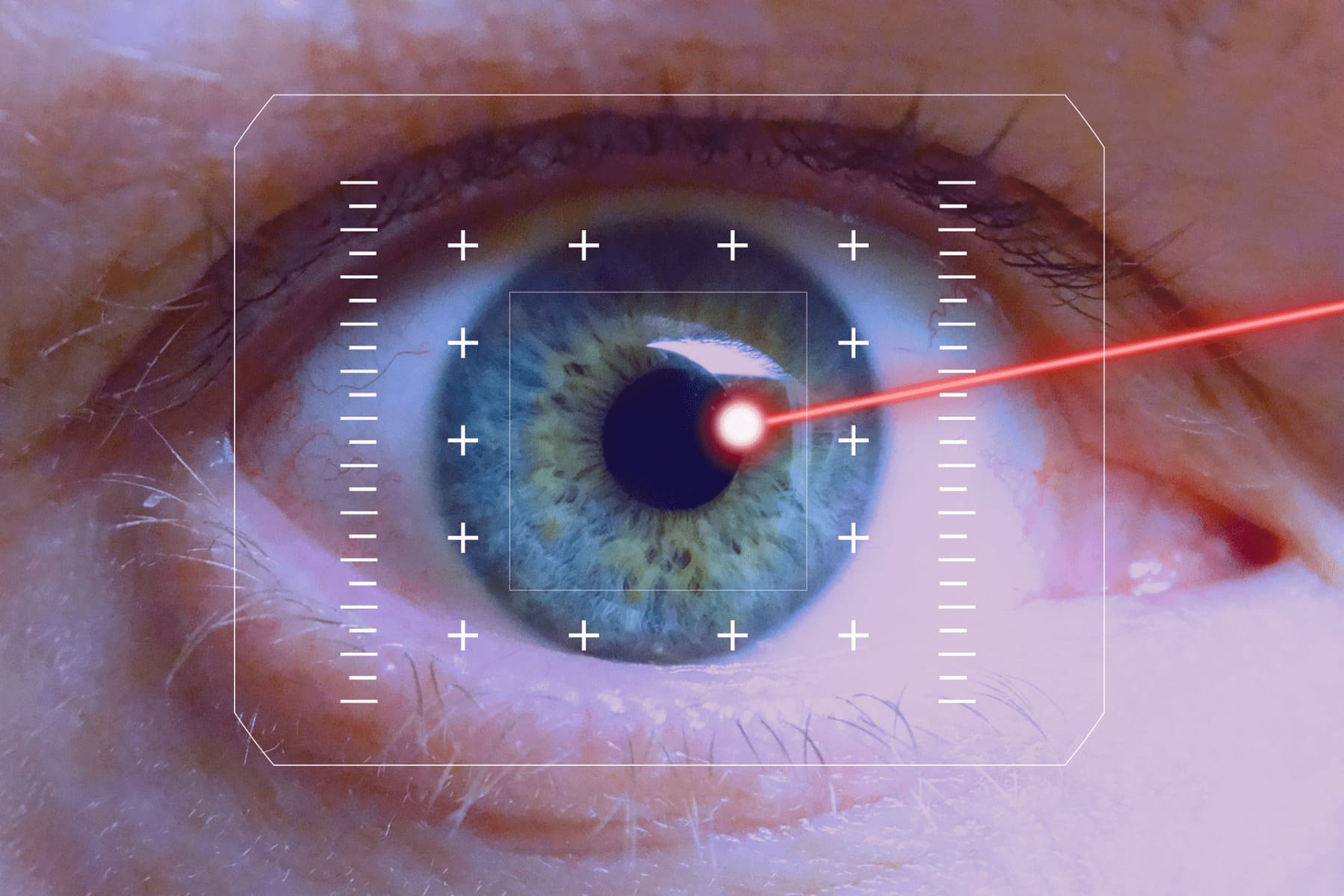 Laser Eye Surgery in Turkey related image