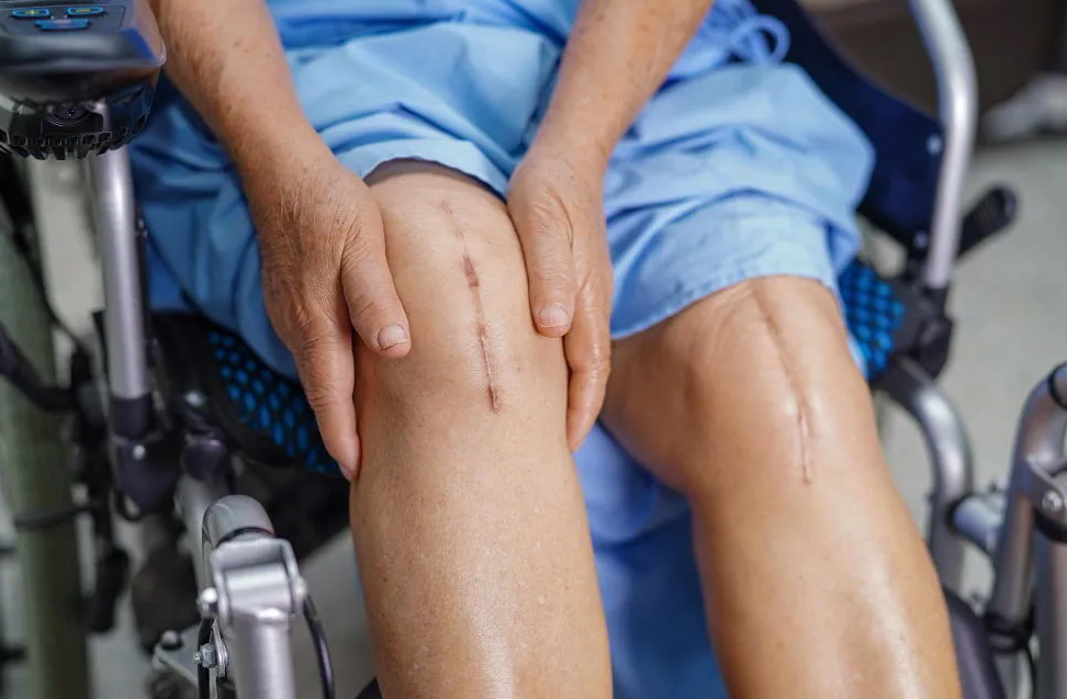 Best and Cheapest Countries for Hip Replacement Surgery Abroad related image