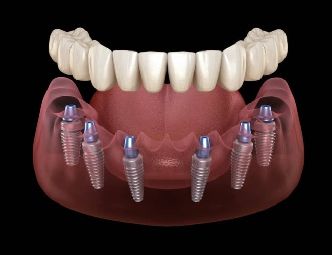 The Best and Cheapest Countries for All-on-6 Dental Implants related image