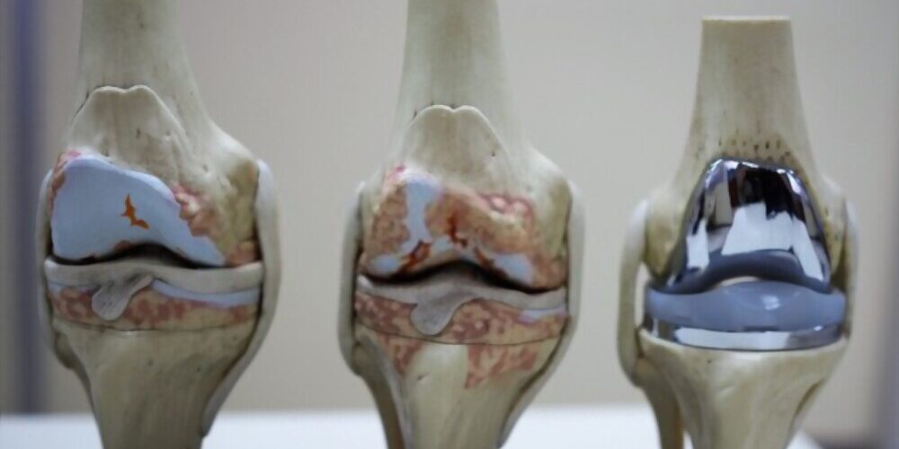 Best and Cheapest Countries for Hip Replacement Surgery Abroad related image